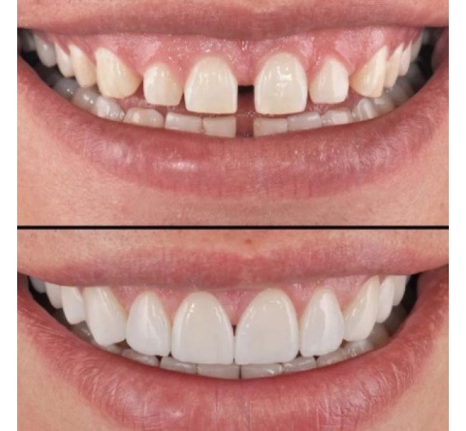 Идеальный улыбка с зубными винирами Perfect Smile Veneers White (kz059-hbr)