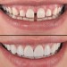 Вініри зубні Perfect Smile Veneers змінні White - ідеальний усмішка за мить!