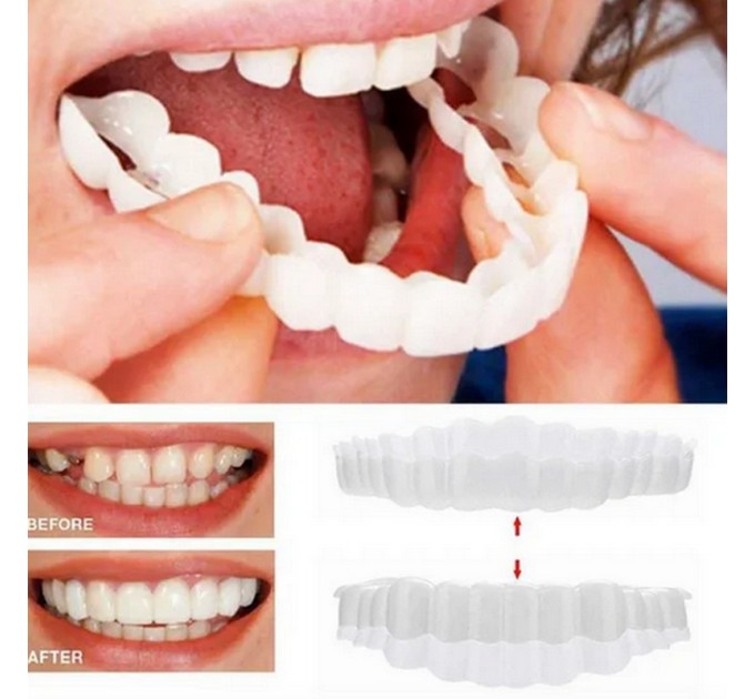 Snap On Smile Veneers: Идеальные съемные виниры для верхней и нижней челюсти